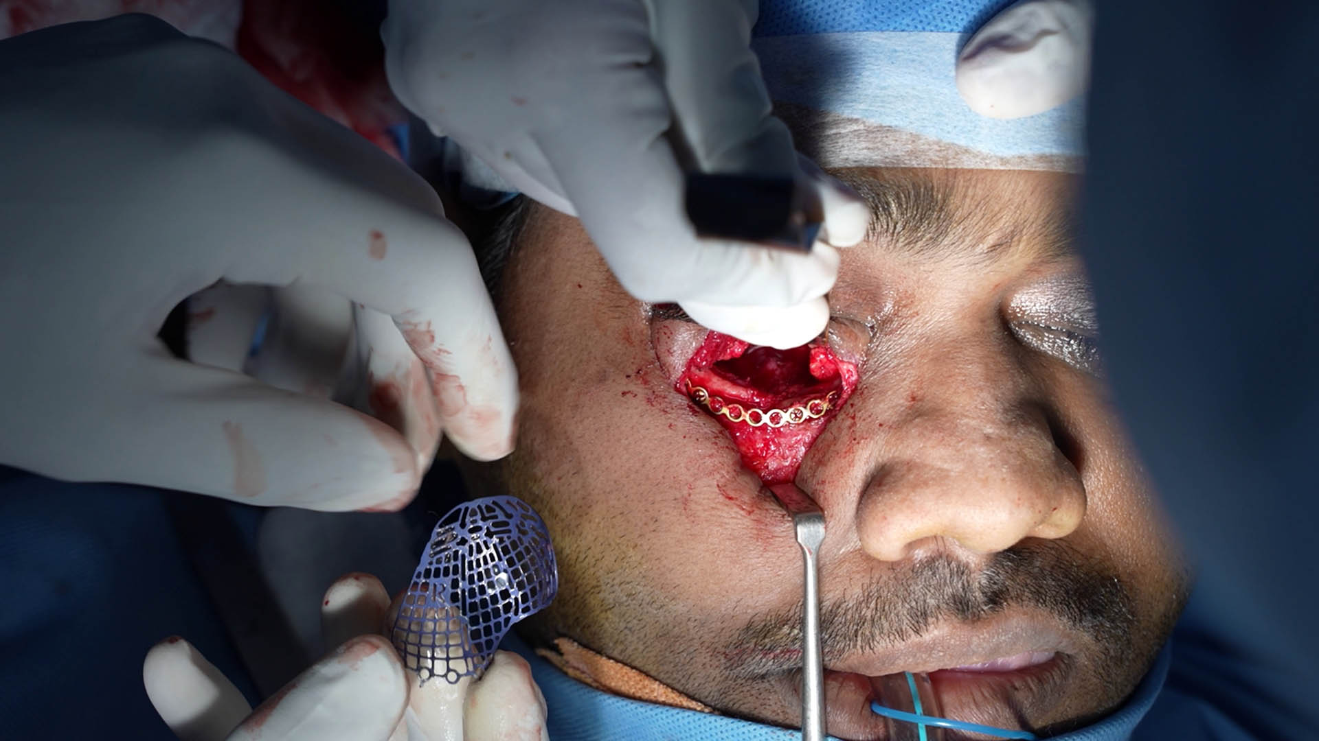Orbital Trauma Surgery